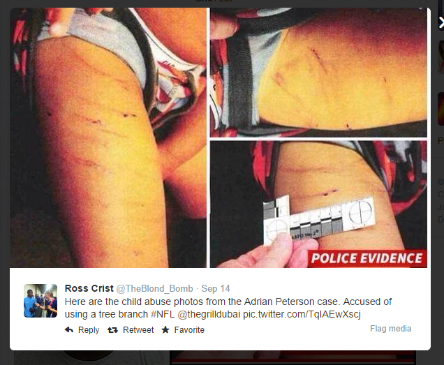 adrian peterson scars