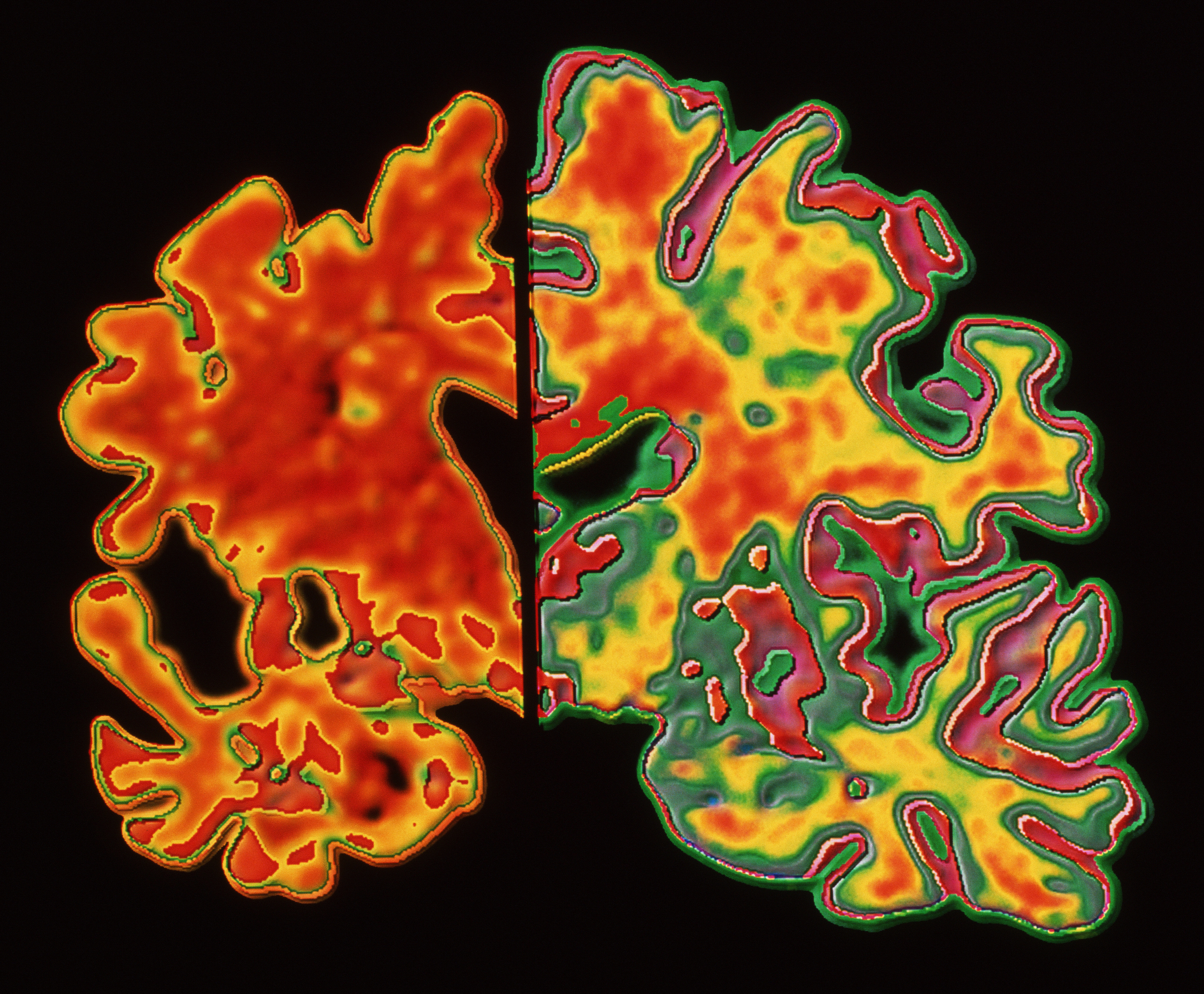 Alzheimers brain